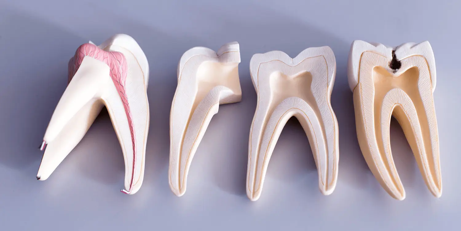Root Canal Treatment in Delhi
